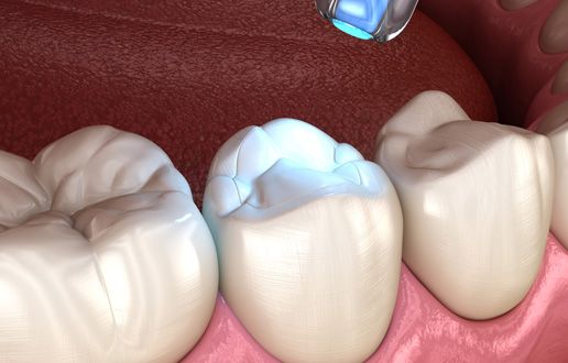 Tooth Restauration